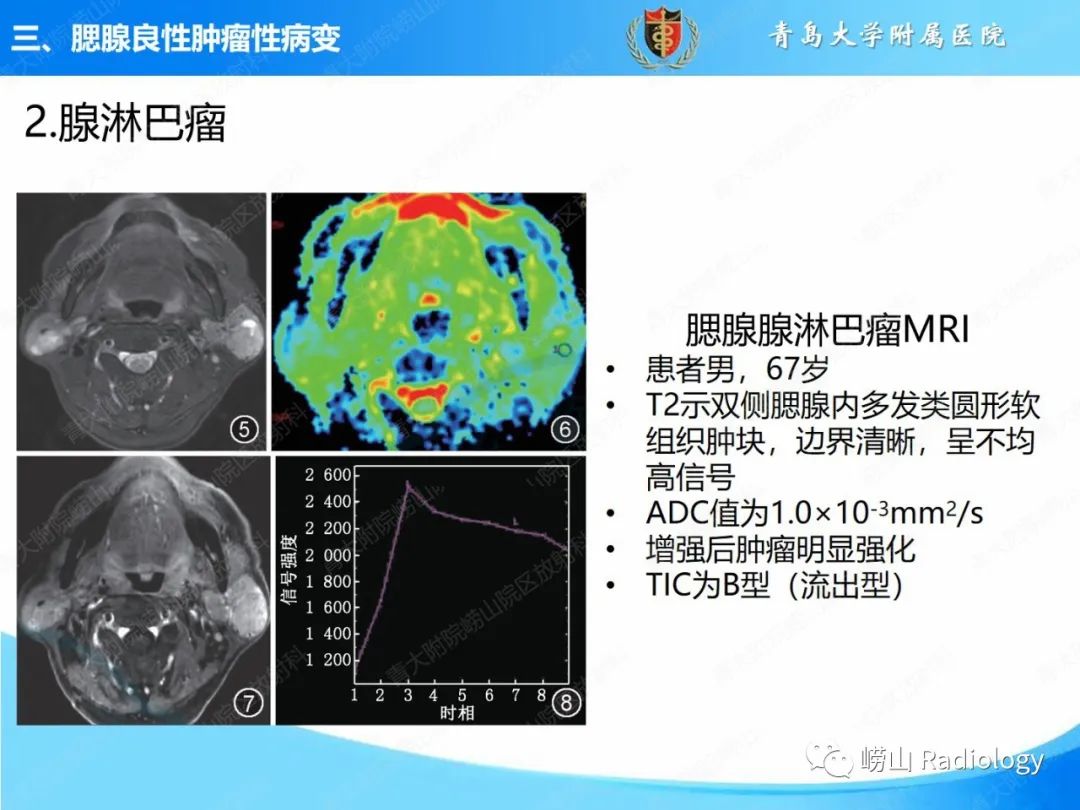 影像PPT - 【PPT】腮腺肿瘤性病变的影像学诊断思路及功能MRI价值评估-18