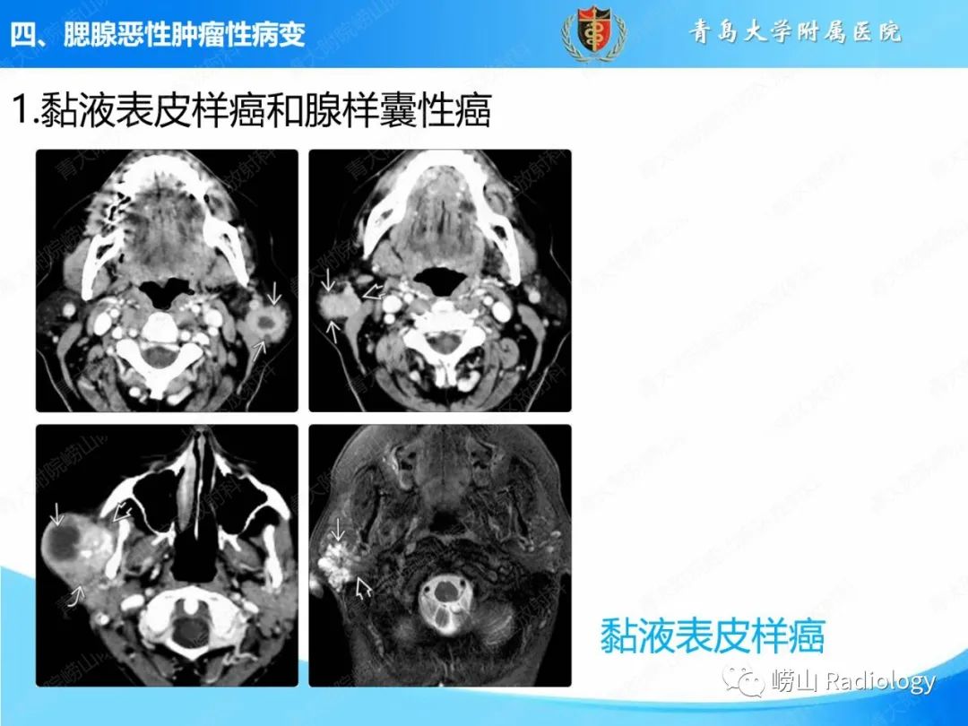 影像PPT - 【PPT】腮腺肿瘤性病变的影像学诊断思路及功能MRI价值评估-21