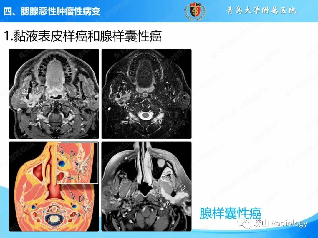 影像PPT - 【PPT】腮腺肿瘤性病变的影像学诊断思路及功能MRI价值评估-22