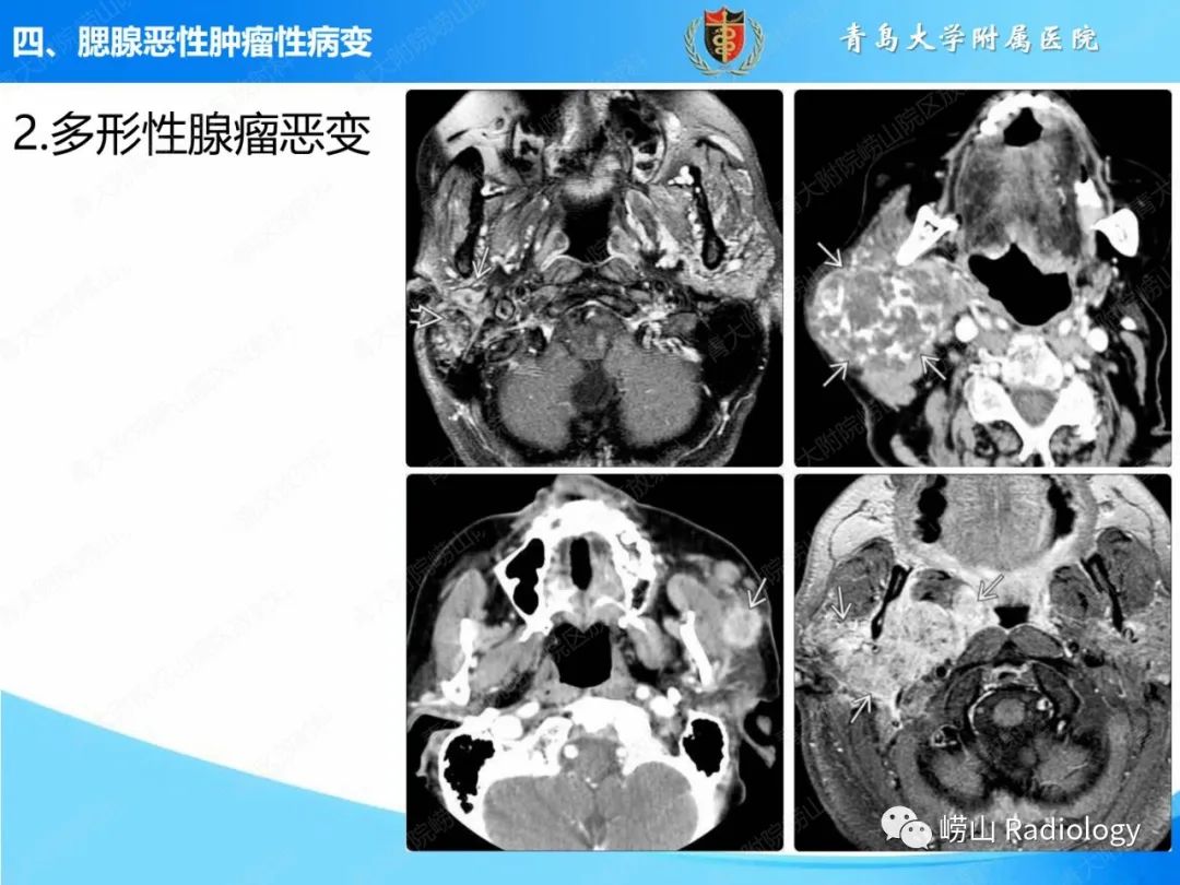 影像PPT - 【PPT】腮腺肿瘤性病变的影像学诊断思路及功能MRI价值评估-25