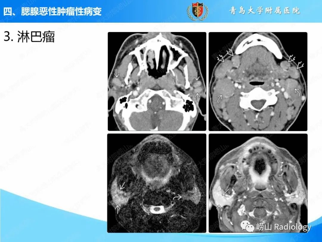 影像PPT - 【PPT】腮腺肿瘤性病变的影像学诊断思路及功能MRI价值评估-28