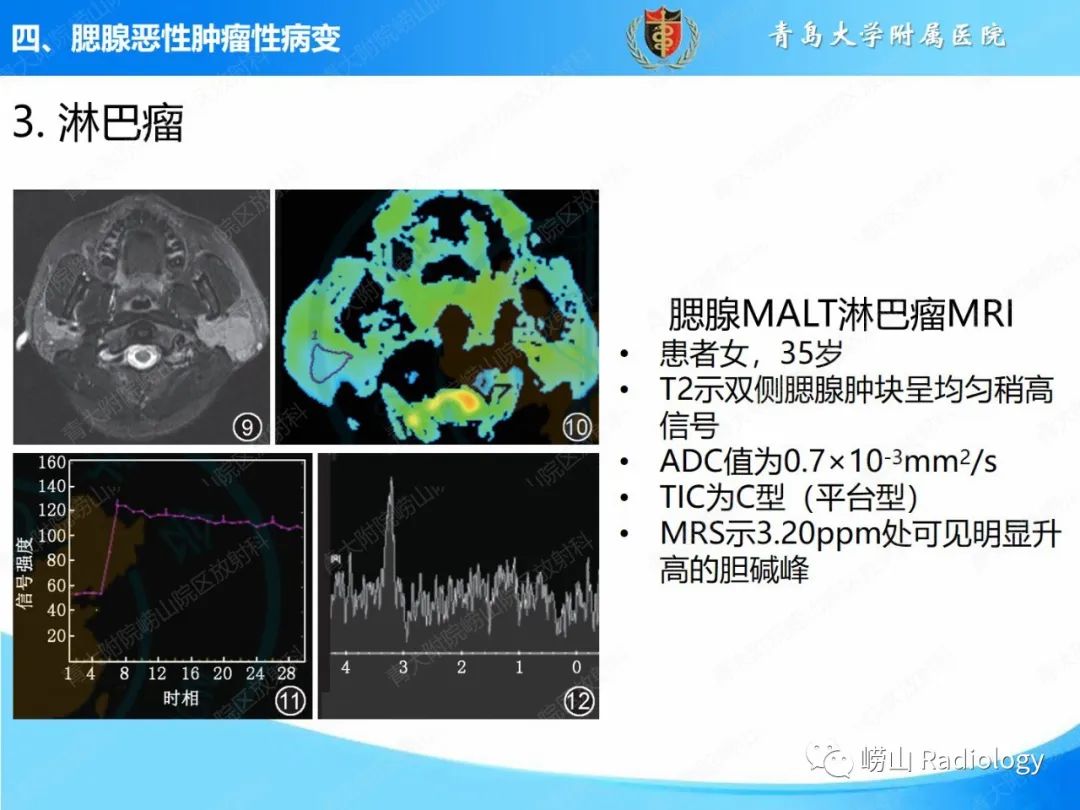 影像PPT - 【PPT】腮腺肿瘤性病变的影像学诊断思路及功能MRI价值评估-29