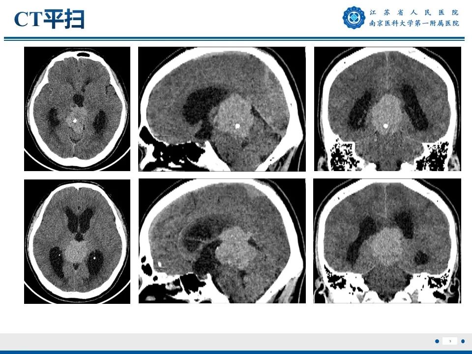 影像PPT - 【PPT】松果体生殖细胞瘤-4