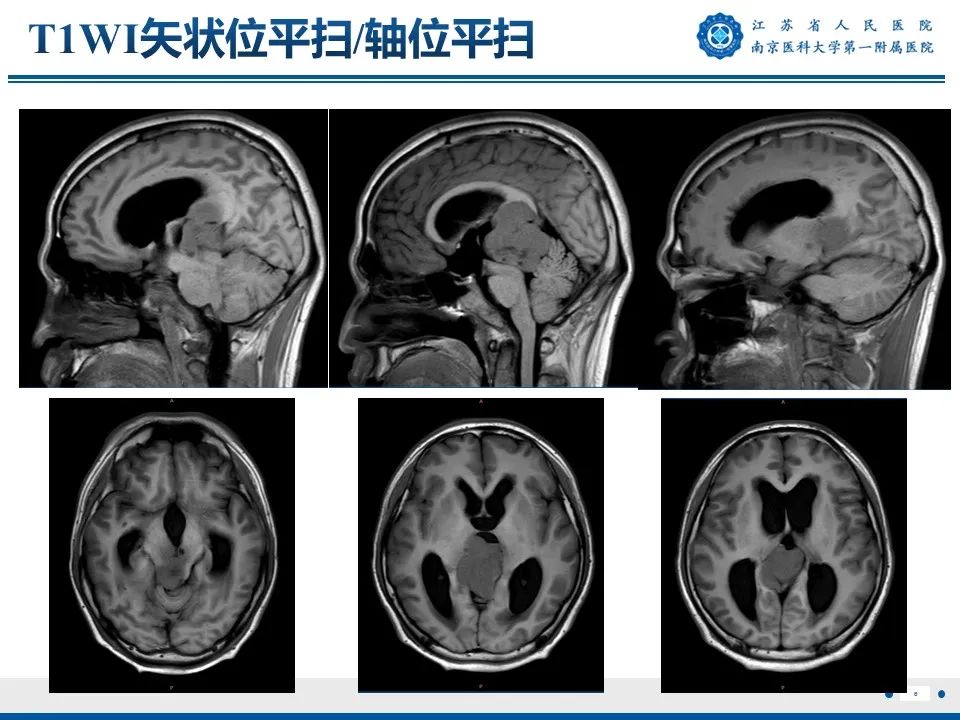影像PPT - 【PPT】松果体生殖细胞瘤-7