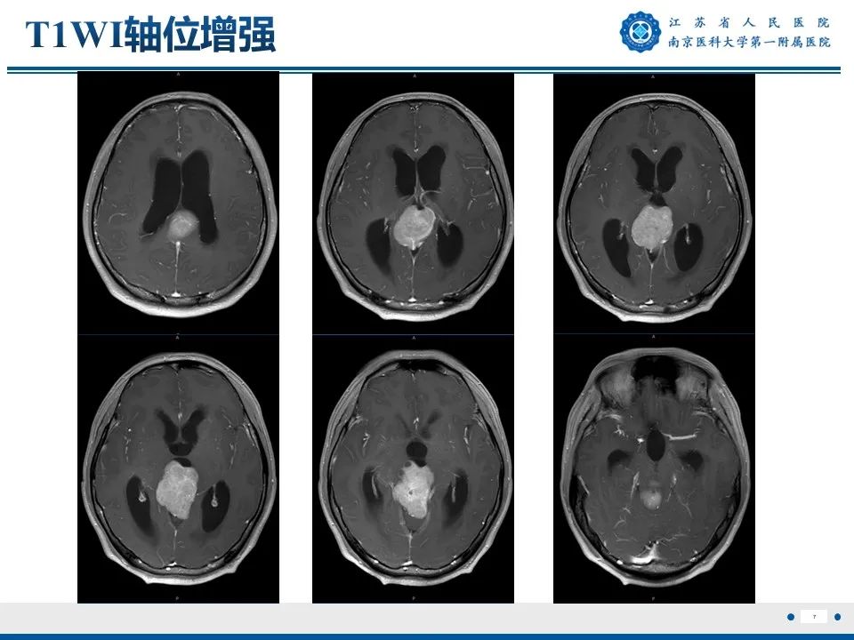 影像PPT - 【PPT】松果体生殖细胞瘤-8