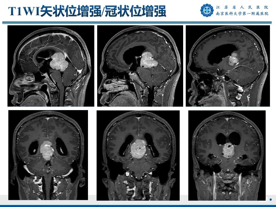 影像PPT - 【PPT】松果体生殖细胞瘤-9