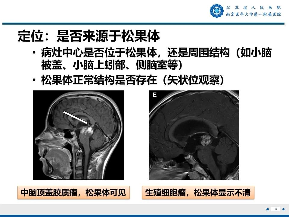 影像PPT - 【PPT】松果体生殖细胞瘤-15