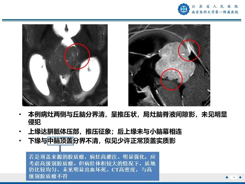 影像PPT - 【PPT】松果体生殖细胞瘤-16