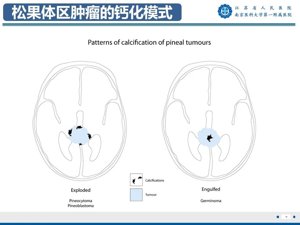 影像PPT - 【PPT】松果体生殖细胞瘤-19