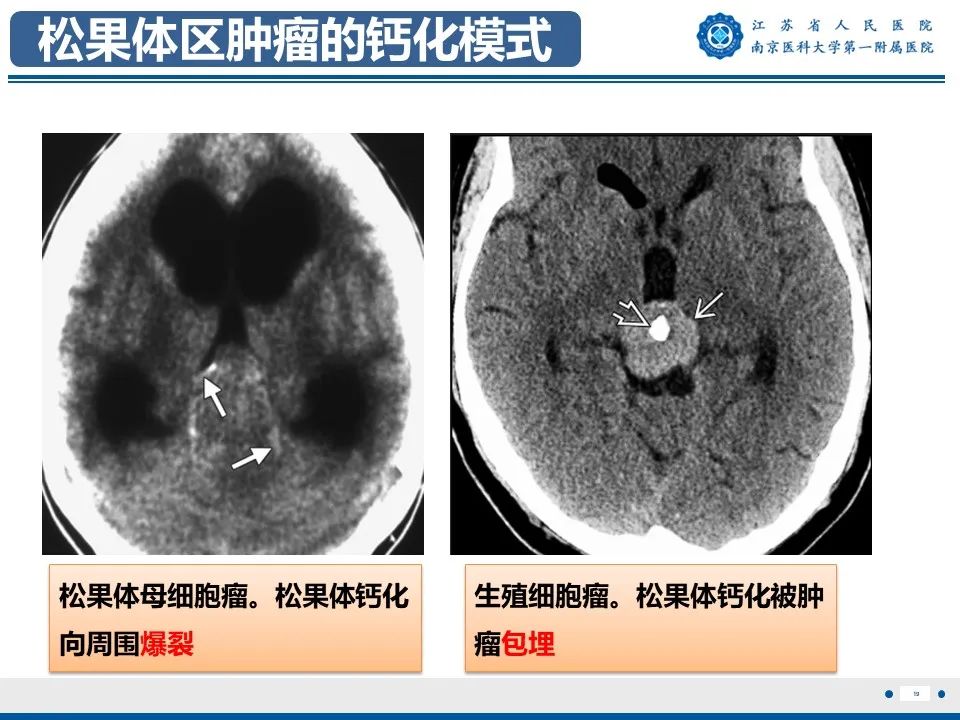 影像PPT - 【PPT】松果体生殖细胞瘤-20