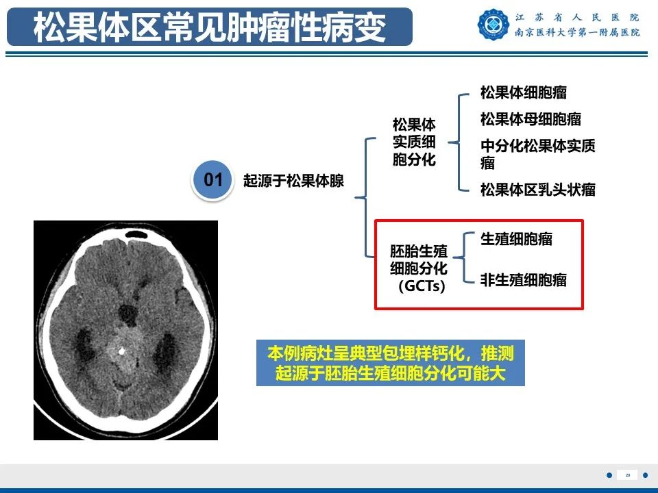 影像PPT - 【PPT】松果体生殖细胞瘤-21
