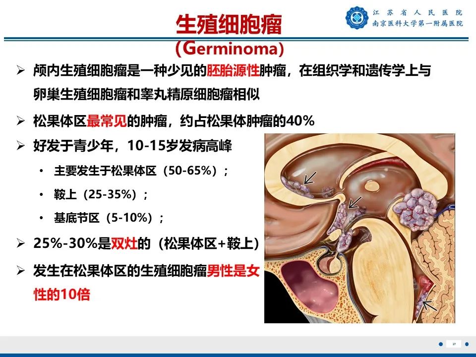 影像PPT - 【PPT】松果体生殖细胞瘤-28