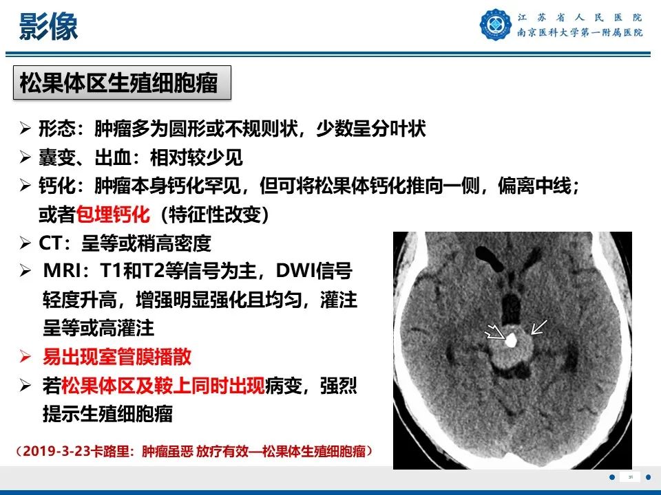 影像PPT - 【PPT】松果体生殖细胞瘤-32