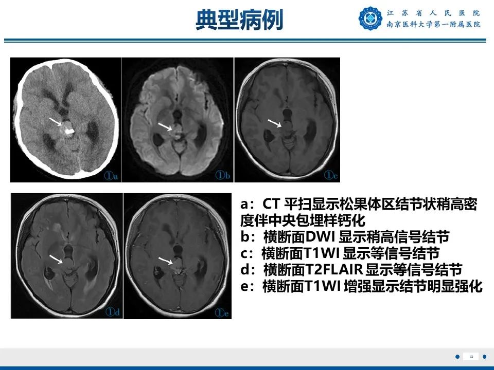 影像PPT - 【PPT】松果体生殖细胞瘤-33
