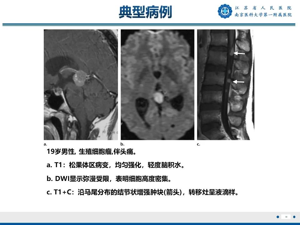 影像PPT - 【PPT】松果体生殖细胞瘤-34