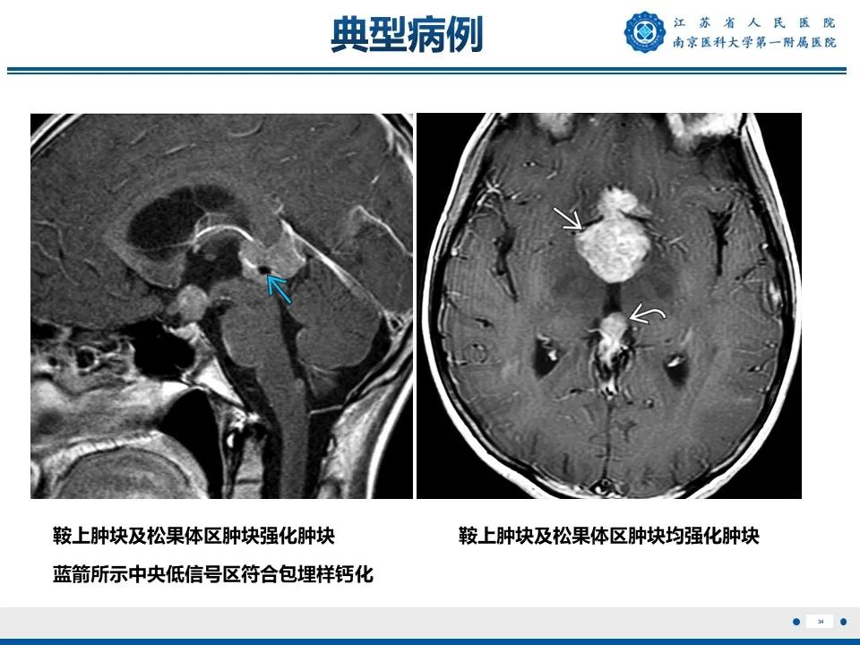 影像PPT - 【PPT】松果体生殖细胞瘤-35