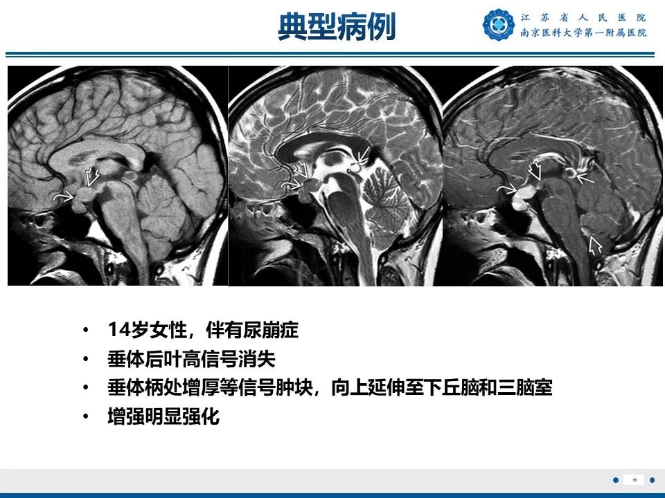 影像PPT - 【PPT】松果体生殖细胞瘤-37