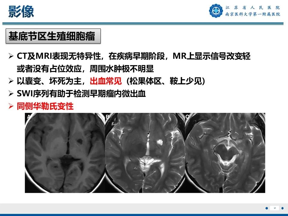 影像PPT - 【PPT】松果体生殖细胞瘤-38