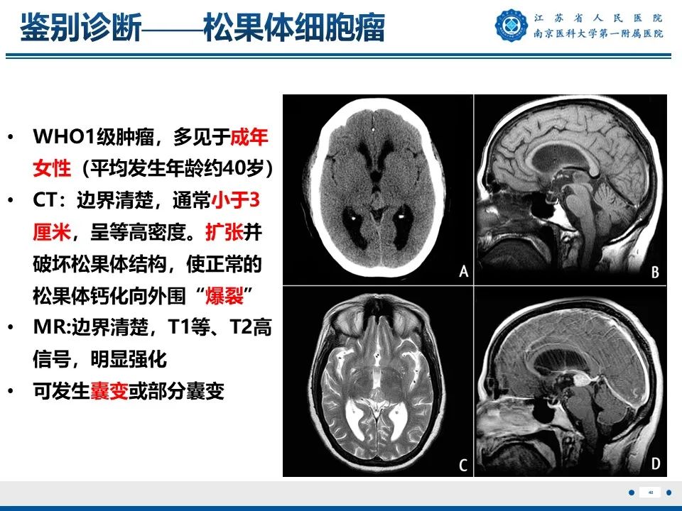 影像PPT - 【PPT】松果体生殖细胞瘤-41