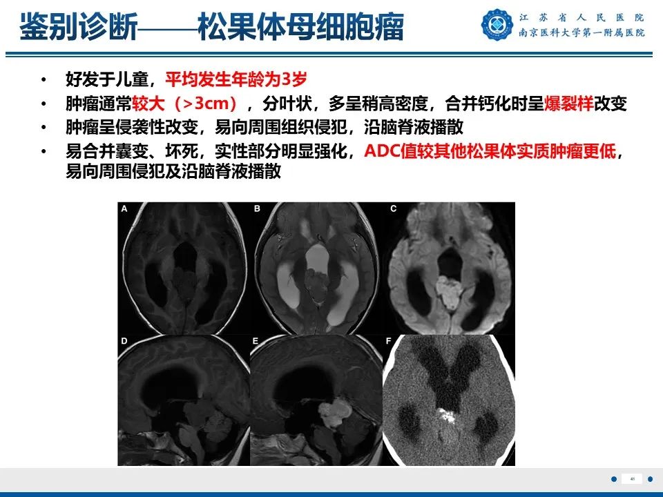 影像PPT - 【PPT】松果体生殖细胞瘤-42