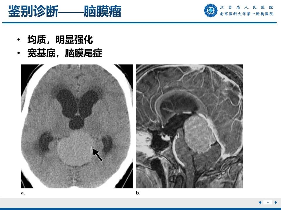 影像PPT - 【PPT】松果体生殖细胞瘤-43