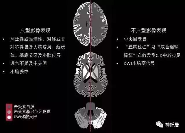 影像PPT - 丘脑枕征-2 影像PPT - 丘脑枕征-2