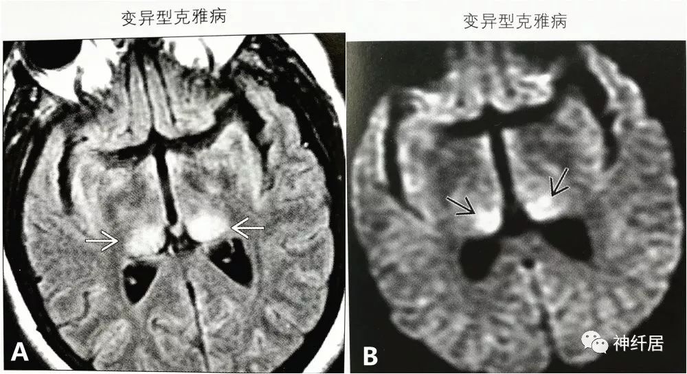 影像PPT - 丘脑枕征-3 影像PPT - 丘脑枕征-3