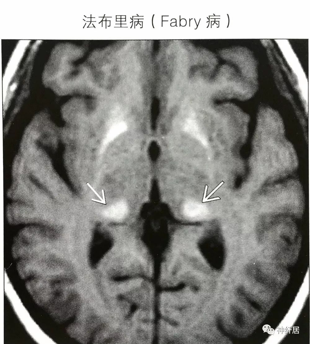 影像PPT - 丘脑枕征-4 影像PPT - 丘脑枕征-4