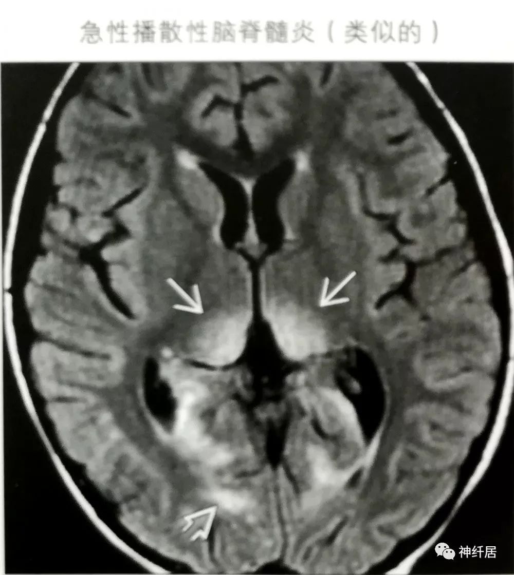 影像PPT - 丘脑枕征-7 影像PPT - 丘脑枕征-7