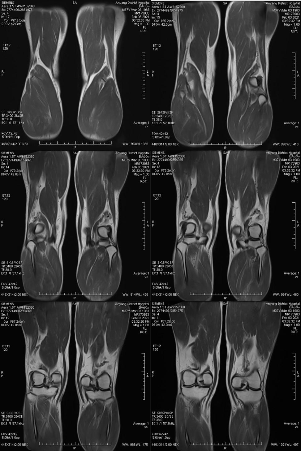 影像PPT - 【病例】腘动脉陷迫综合征1例MR影像-2