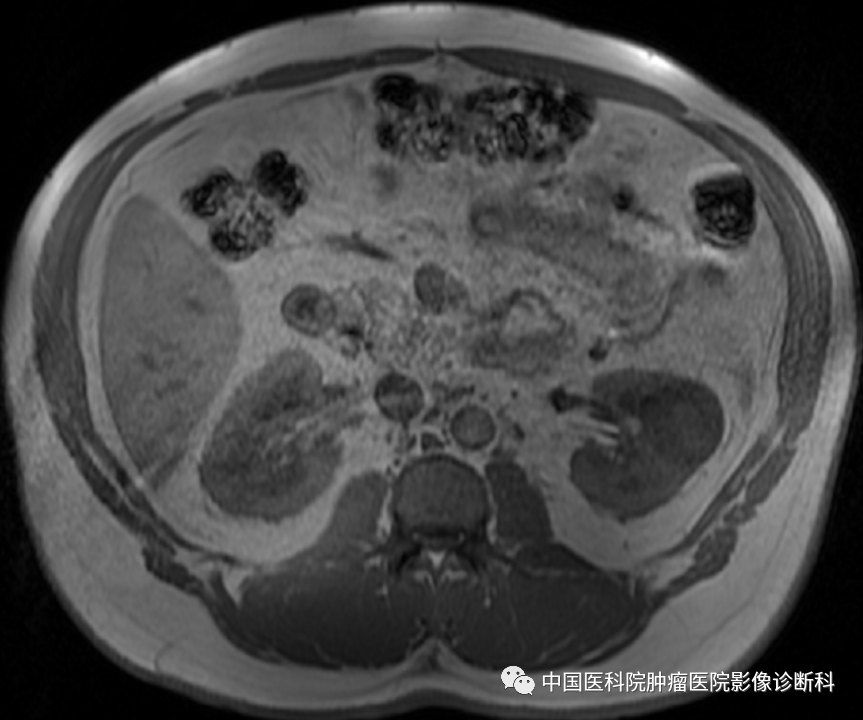 影像PPT - 【病例】左肾肌周细胞瘤1例MR影像-2