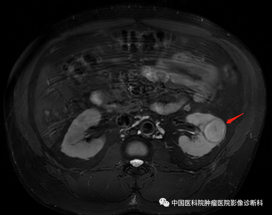 影像PPT - 【病例】左肾肌周细胞瘤1例MR影像-4