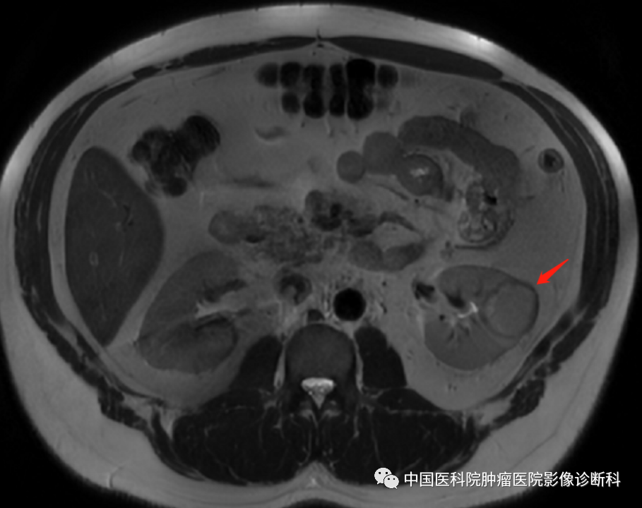影像PPT - 【病例】左肾肌周细胞瘤1例MR影像-5