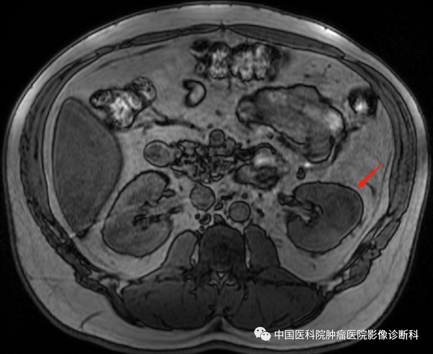 影像PPT - 【病例】左肾肌周细胞瘤1例MR影像-3