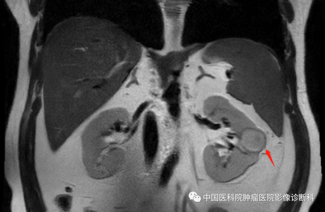 影像PPT - 【病例】左肾肌周细胞瘤1例MR影像-6