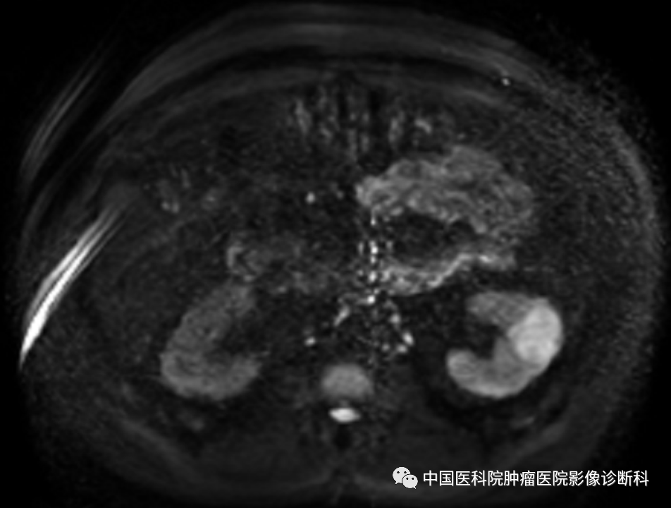 影像PPT - 【病例】左肾肌周细胞瘤1例MR影像-7