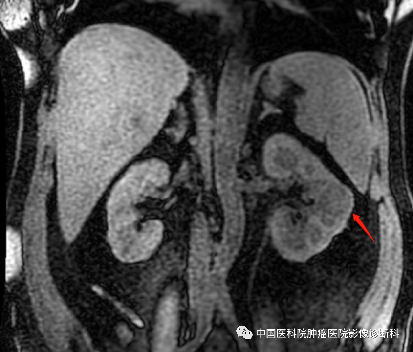 影像PPT - 【病例】左肾肌周细胞瘤1例MR影像-8