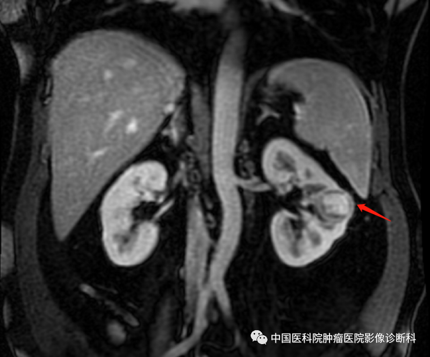 影像PPT - 【病例】左肾肌周细胞瘤1例MR影像-10