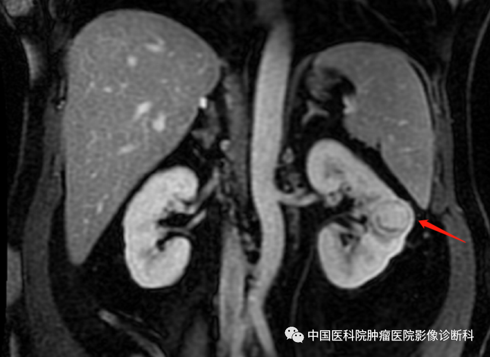 影像PPT - 【病例】左肾肌周细胞瘤1例MR影像-11