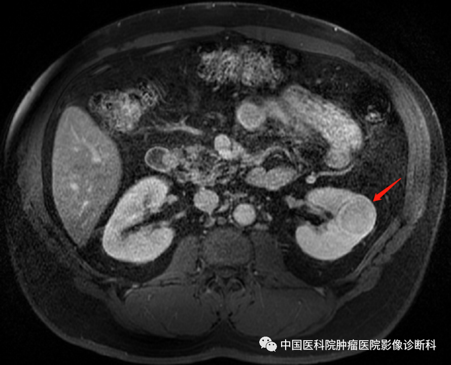 影像PPT - 【病例】左肾肌周细胞瘤1例MR影像-12