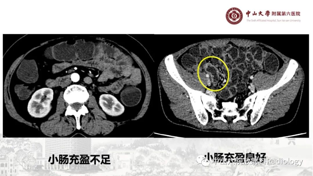 影像PPT - 【PPT】消化道急腹症的影像学诊断思路-6
