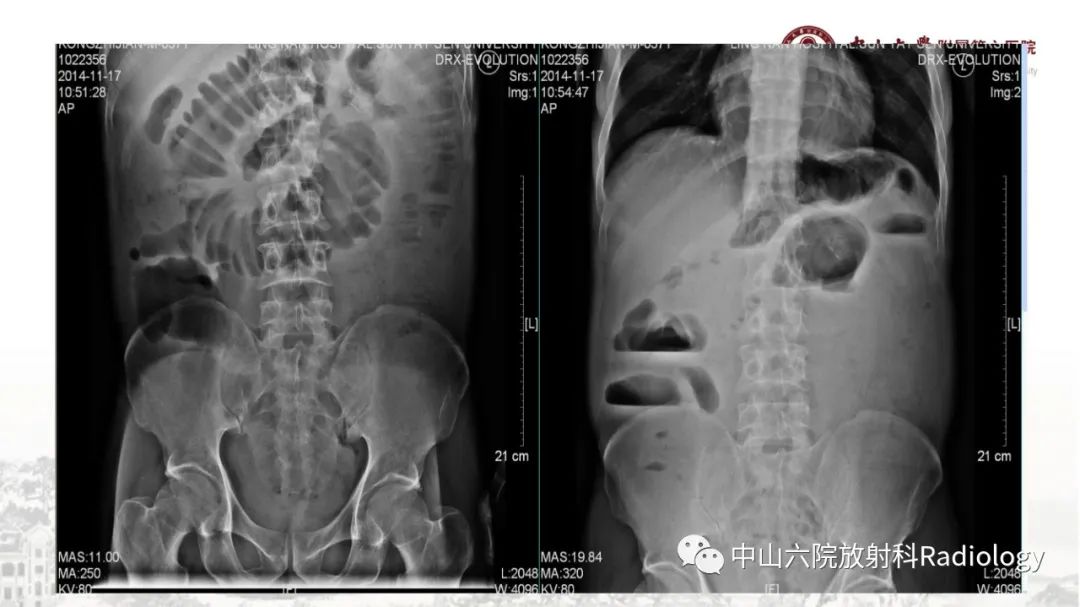 影像PPT - 【PPT】消化道急腹症的影像学诊断思路-17