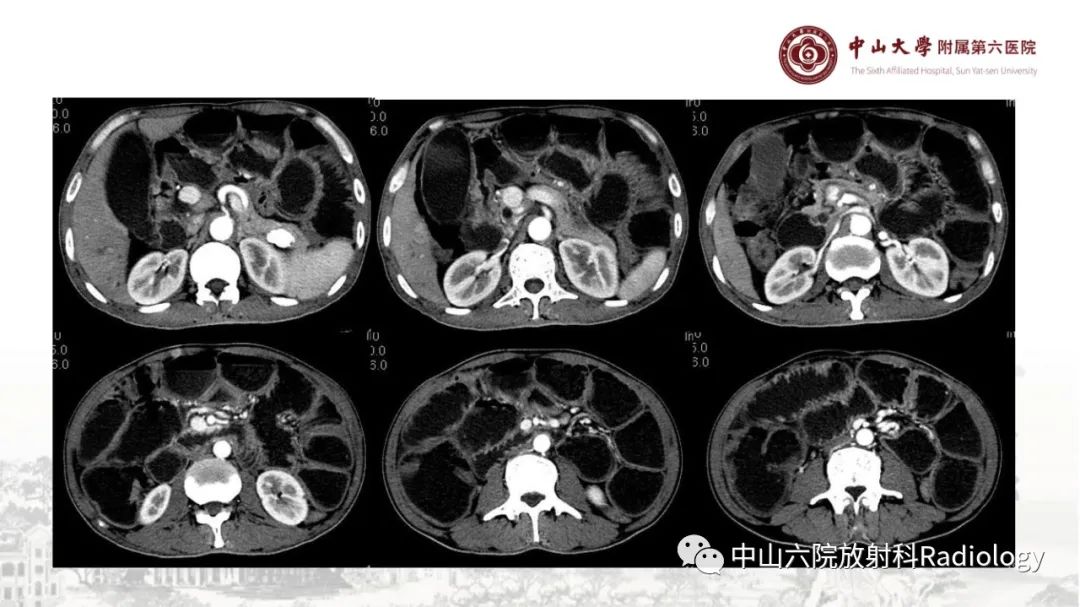 影像PPT - 【PPT】消化道急腹症的影像学诊断思路-18
