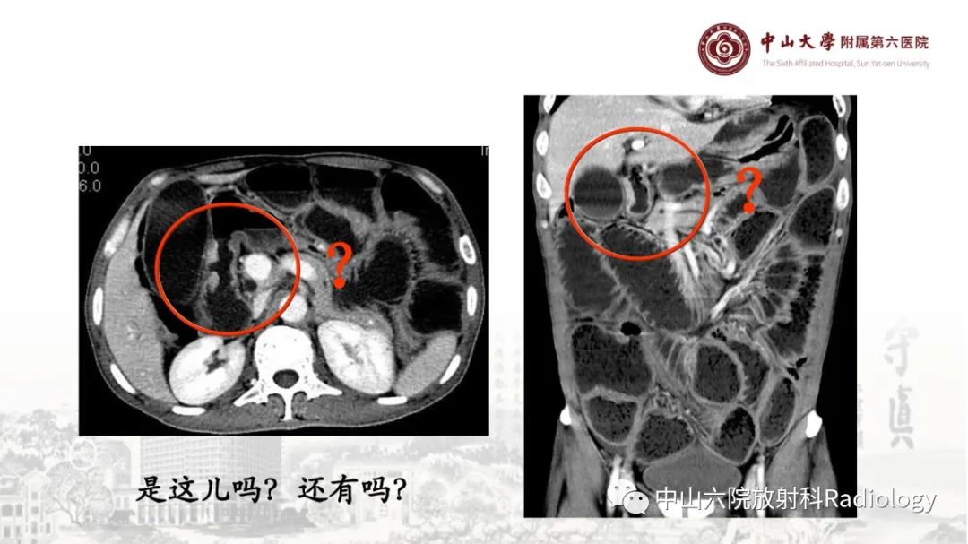 影像PPT - 【PPT】消化道急腹症的影像学诊断思路-20