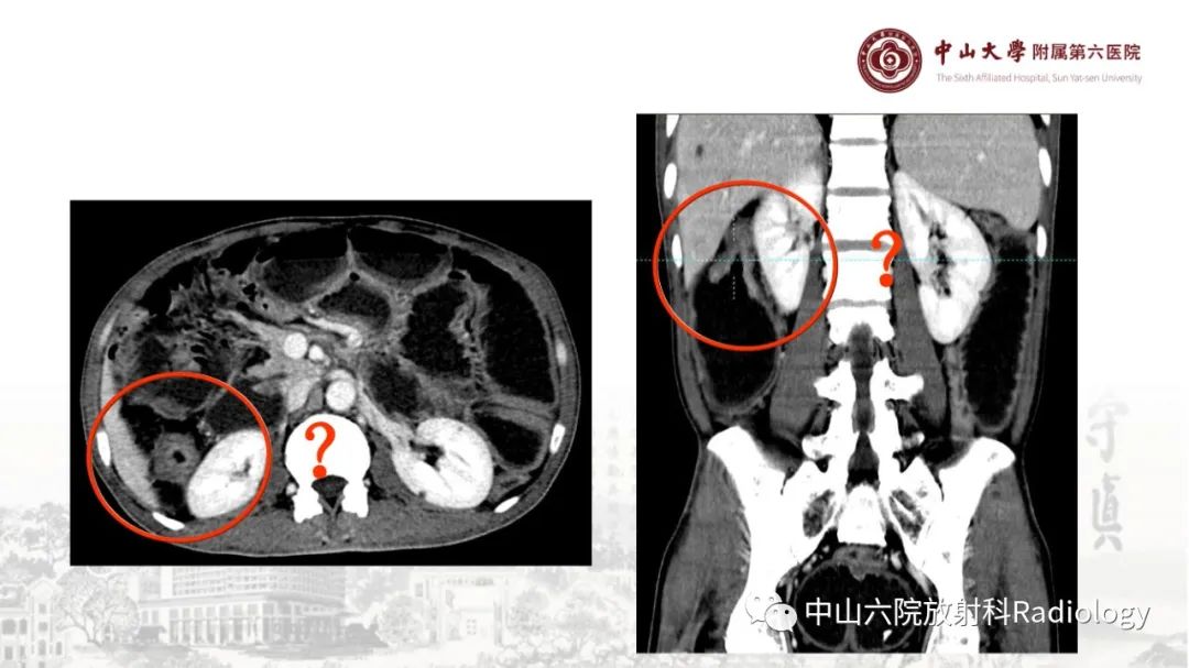 影像PPT - 【PPT】消化道急腹症的影像学诊断思路-21
