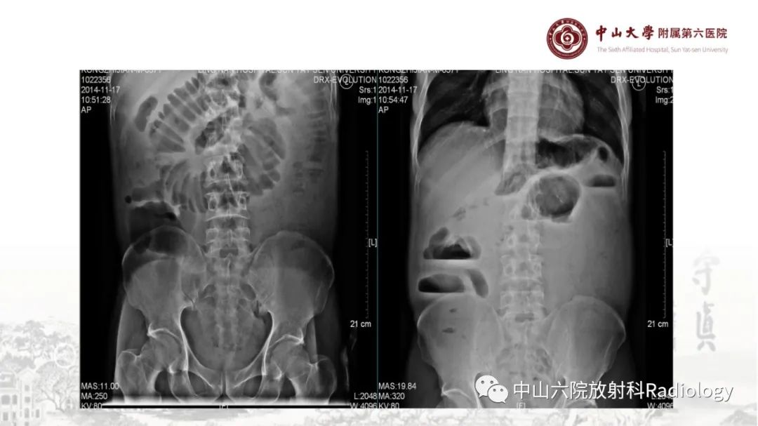 影像PPT - 【PPT】消化道急腹症的影像学诊断思路-22
