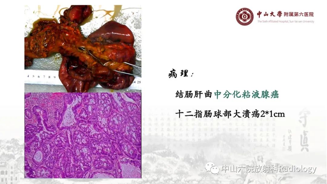 影像PPT - 【PPT】消化道急腹症的影像学诊断思路-23