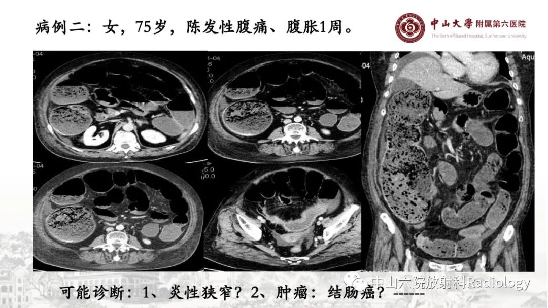 影像PPT - 【PPT】消化道急腹症的影像学诊断思路-24