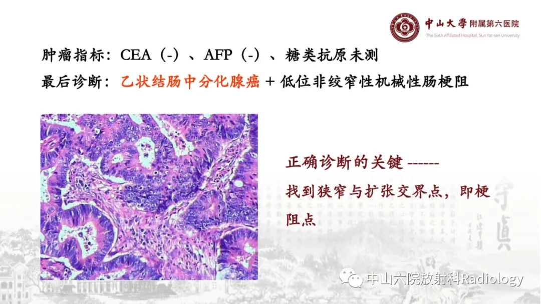 影像PPT - 【PPT】消化道急腹症的影像学诊断思路-25