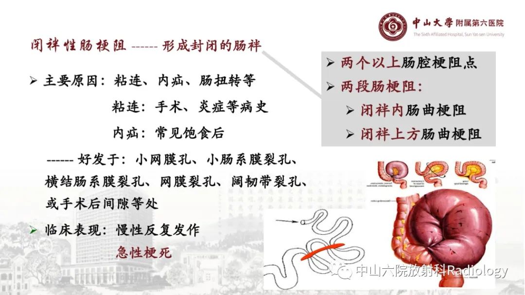 影像PPT - 【PPT】消化道急腹症的影像学诊断思路-26
